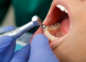 Why Does Dental Cleaning Hurt